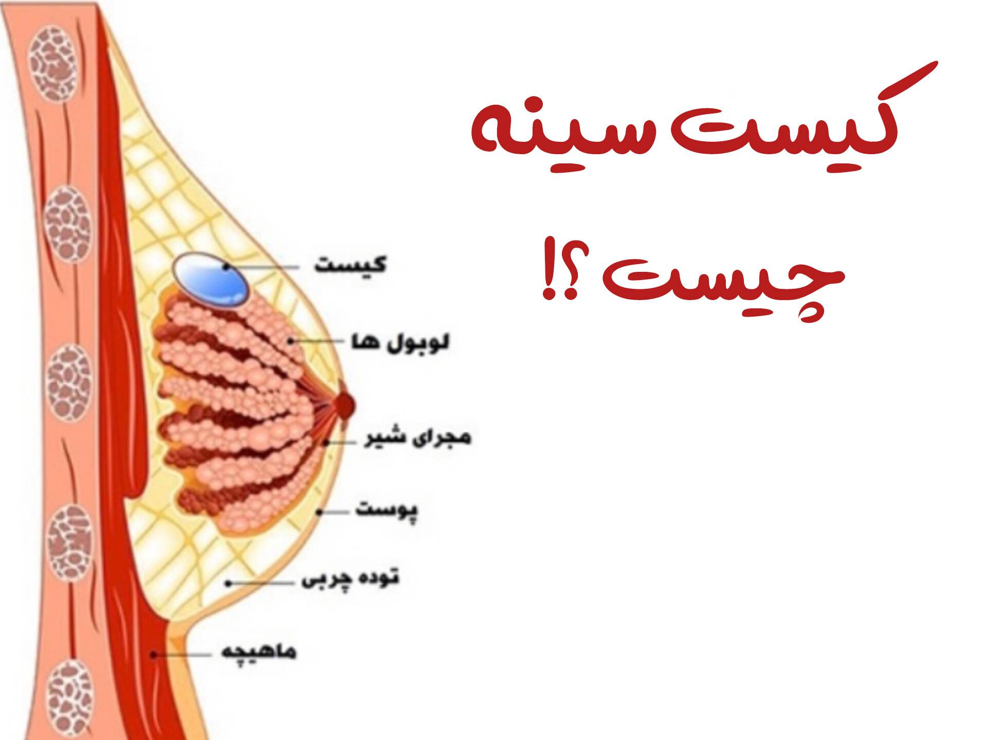 کیست سینه چیست ؟